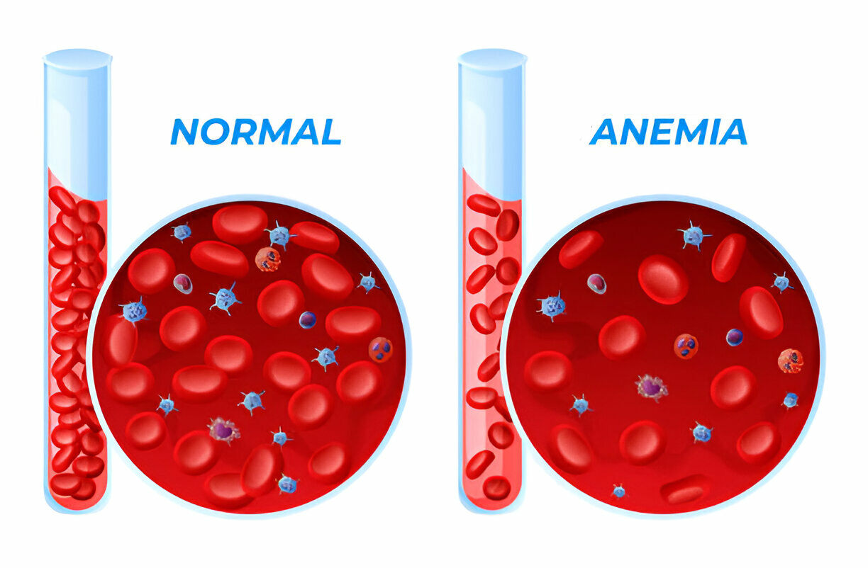 Anemia: entendendo causas e tratamentos - Integralmed